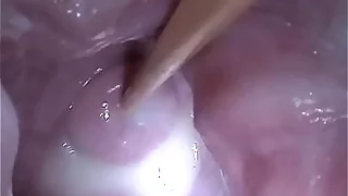 Outsert Semen Cum in Cervix Wide Stretching Pussy Speculum